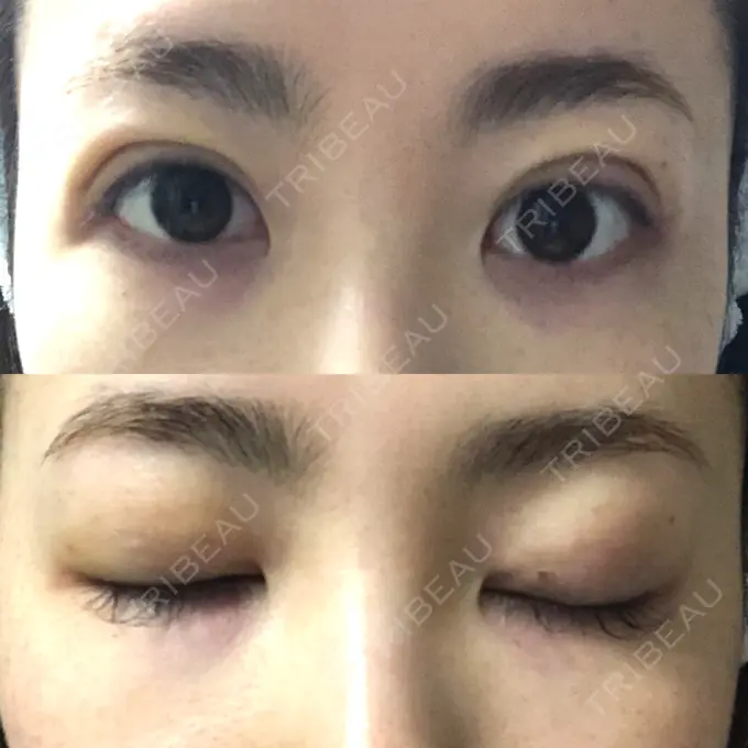 二重埋没 MIL CLINIC OSAKA DAY 4 メイン用