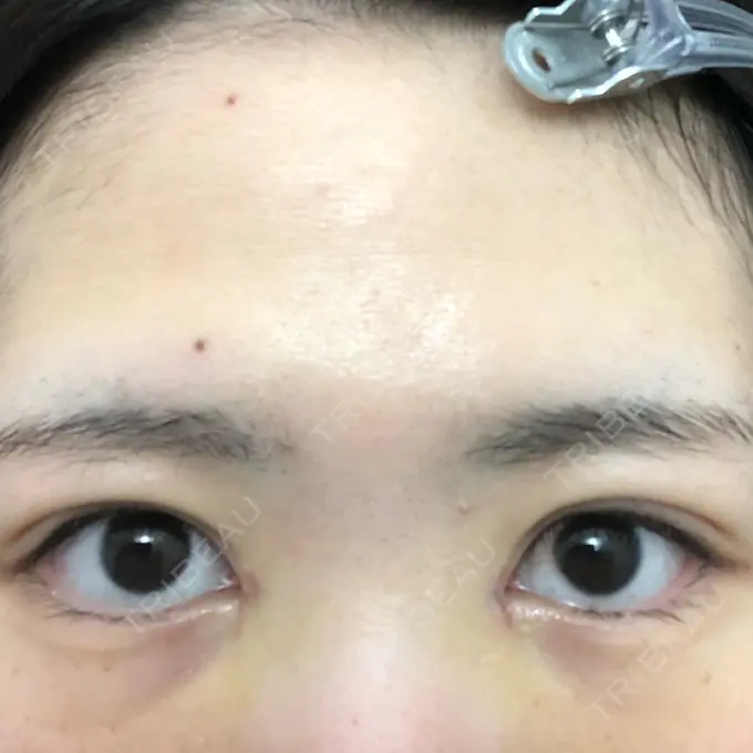 二重埋没 / 二重切開 / 矯正（ワイヤー） 湘南美容クリニック 橋本院 DAY 10 メイン用