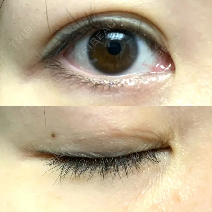 二重埋没 / 目元修正 札幌ル・トロワ ビューティクリニックVogue DAY 5 メイン用