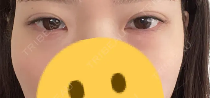 下まぶたの脂肪取り 城本クリニック 福岡院 DAY 1 メイン用