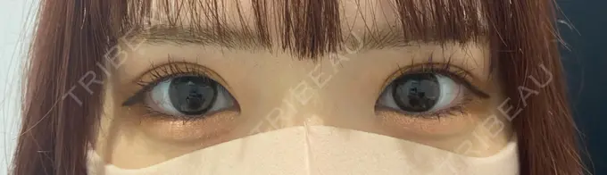 二重埋没 / タレ目形成・グラマラスライン（切開） R Beauty CLINIC 銀座院 AFTER メイン用