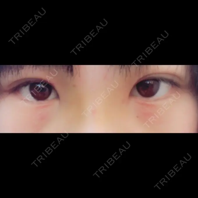 隆鼻術 湘南美容クリニック 柏院 DAY 3 メイン用