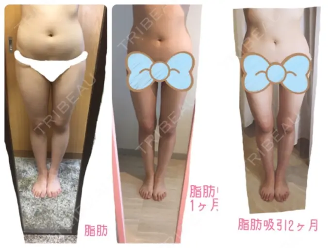 脂肪吸引（脚） / 脂肪吸引（お腹） / 脂肪吸引（お尻） ヨンセスリムライン DAY 60 メイン用