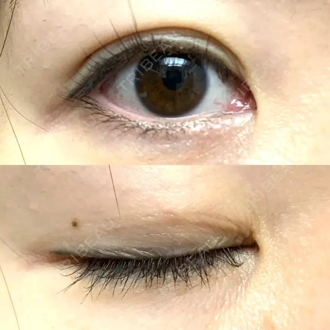 二重埋没 / 目元修正 札幌ル・トロワ ビューティクリニックVogue DAY 6 メイン用