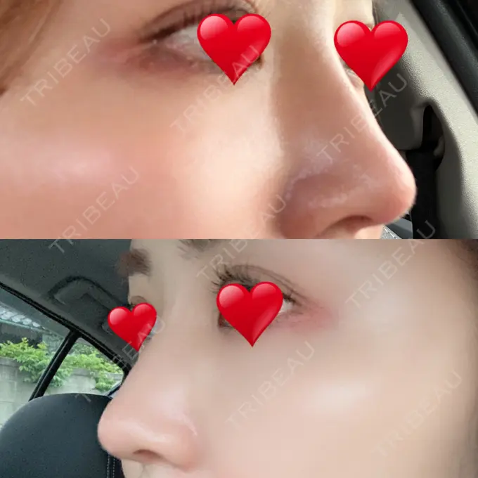 隆鼻術 / 鼻尖形成（切開） / 軟骨移植 / 骨切幅寄せ THE ROPPONGI CLINIC（ザ 六本木クリニック） AFTER メイン用