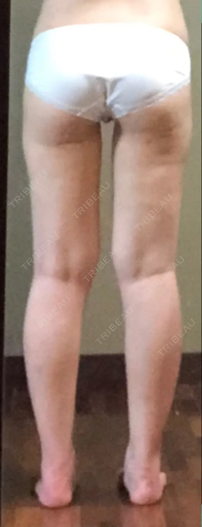 脂肪吸引（脚） T.O.P整形外科 AFTER メイン用