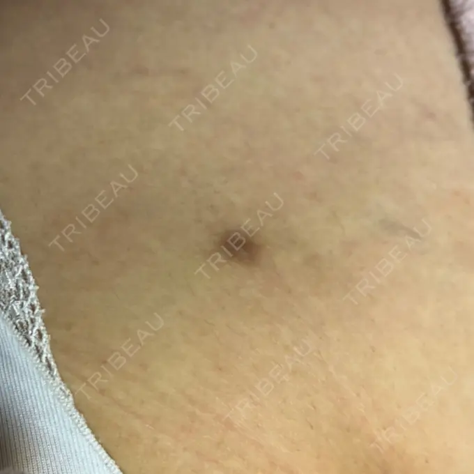 脂肪吸引（脚） T.O.P整形外科 DAY 227 メイン用