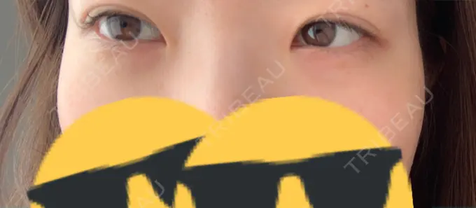 下まぶたの脂肪取り 城本クリニック 福岡院 DAY 4 メイン用