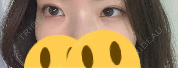 下まぶたの脂肪取り 城本クリニック 福岡院 AFTER メイン用