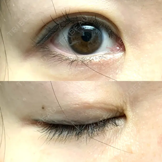 二重埋没 / 目元修正 札幌ル・トロワ ビューティクリニックVogue DAY 7 メイン用