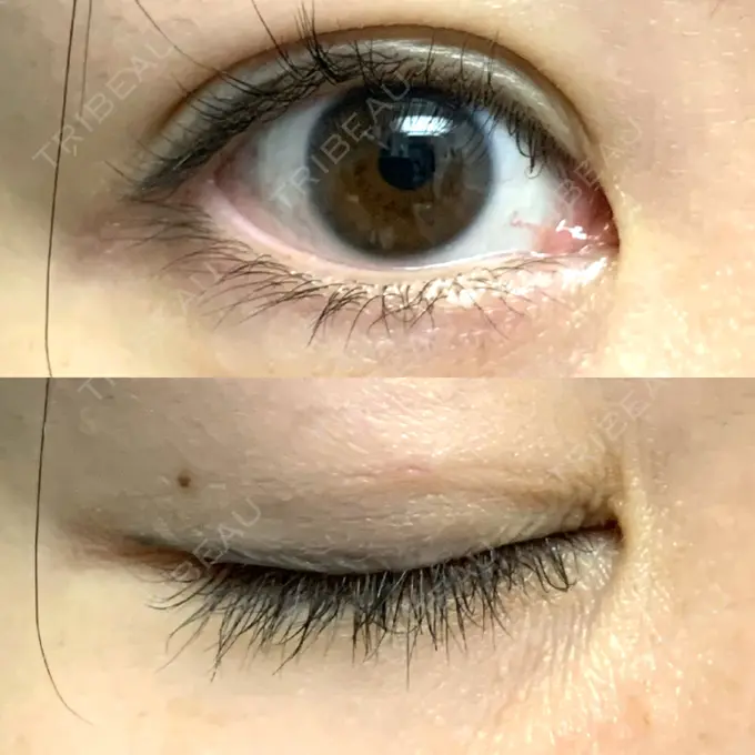 二重埋没 / 目元修正 札幌ル・トロワ ビューティクリニックVogue DAY 10 メイン用