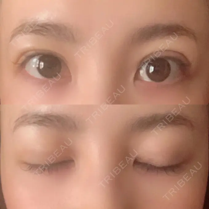 二重埋没 MIL CLINIC OSAKA DAY 5 メイン用