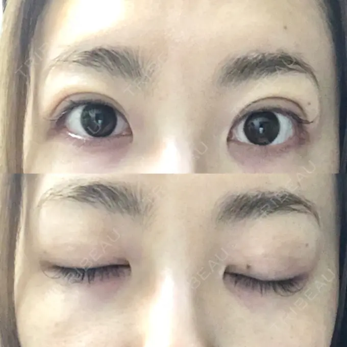 二重埋没 MIL CLINIC OSAKA DAY 6 メイン用