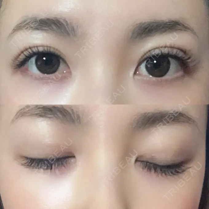 二重埋没 MIL CLINIC OSAKA DAY 8 メイン用