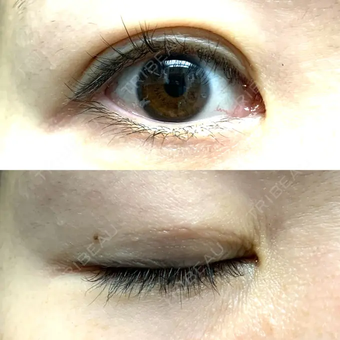 二重埋没 / 目元修正 札幌ル・トロワ ビューティクリニックVogue DAY 11 メイン用