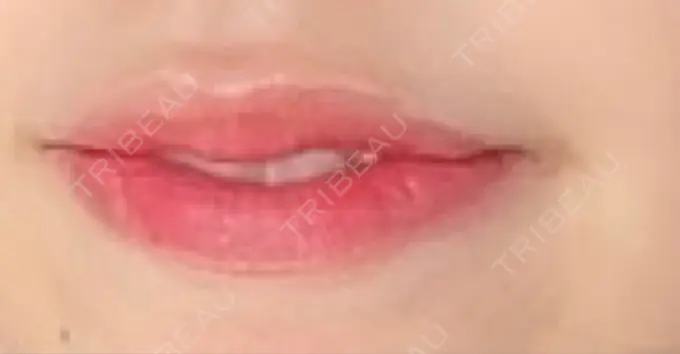 ヒアルロン酸注入（唇） / ボトックス（口角） ルラ美容クリニック 高田馬場院 DAY 298 メイン用