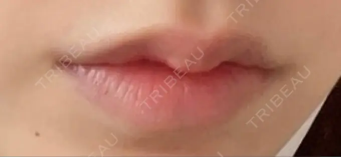 ヒアルロン酸注入（唇） / ボトックス（口角） ルラ美容クリニック 高田馬場院 AFTER メイン用