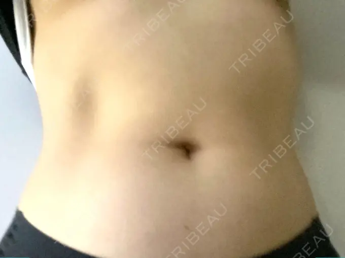 GLP-1ダイエット 湘南美容クリニック 横須賀中央院 DAY 10 メイン用