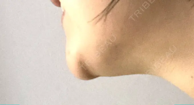 脂肪溶解注射（顔） TCB東京中央美容外科 横浜院 DAY 6 メイン用