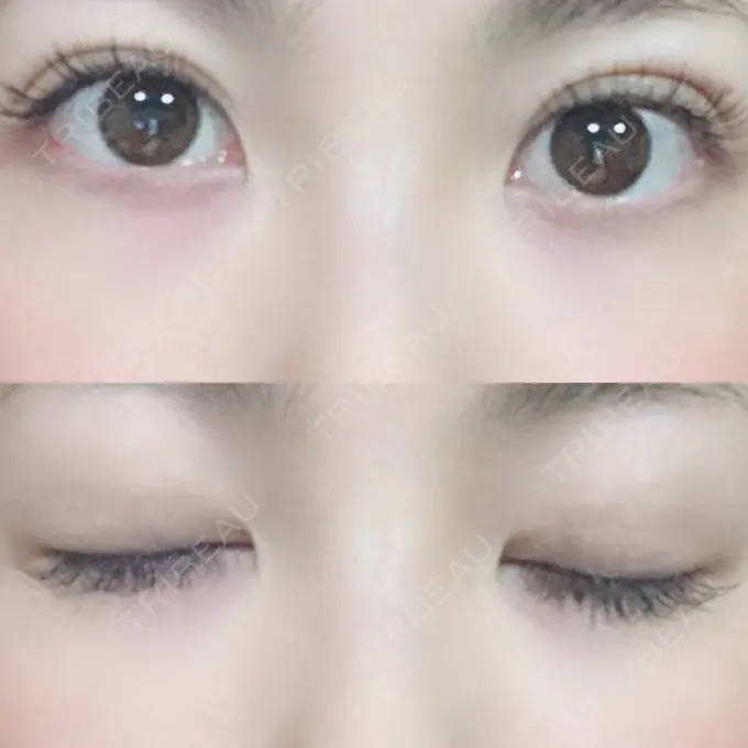 二重埋没 MIL CLINIC OSAKA DAY 11 メイン用