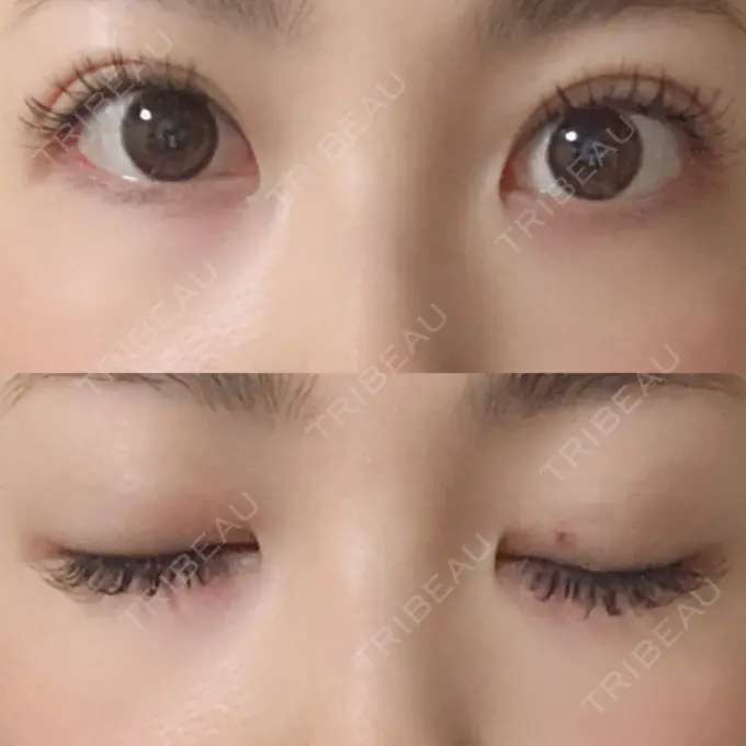 二重埋没 MIL CLINIC OSAKA DAY 16 メイン用