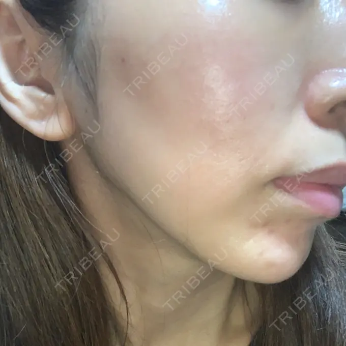 糸リフト MIL CLINIC OSAKA DAY 12 メイン用