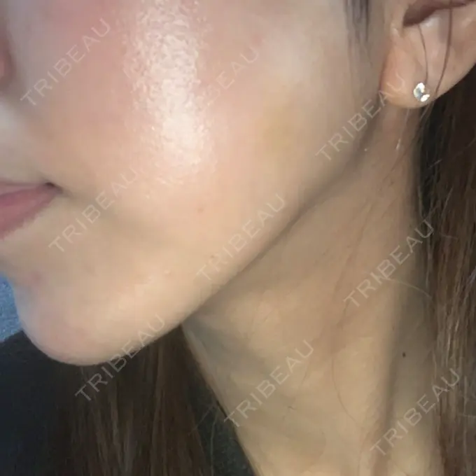 糸リフト MIL CLINIC OSAKA DAY 12 メイン用