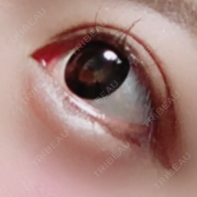 ヒアルロン酸注入（涙袋） プライベートスキンクリニック 梅田本院 DAY 49 メイン用