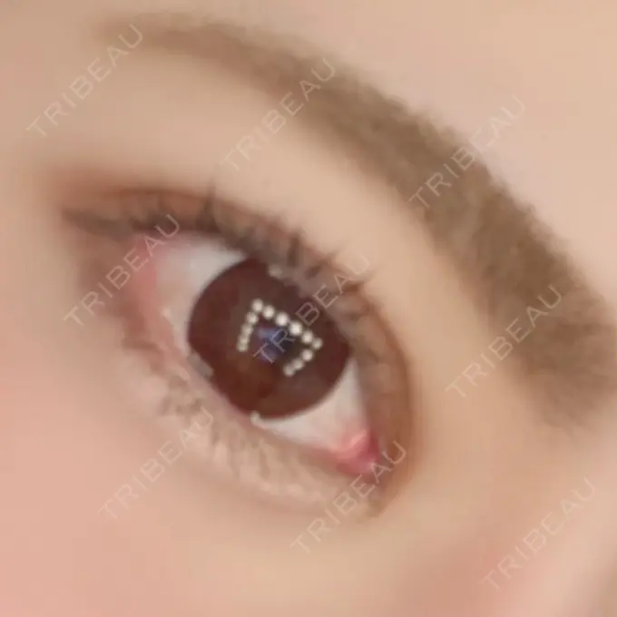 ヒアルロン酸注入（涙袋） プライベートスキンクリニック 梅田本院 AFTER メイン用