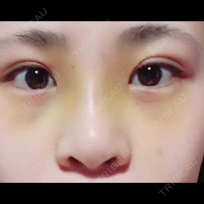 隆鼻術 湘南美容クリニック 柏院 DAY 4 メイン用