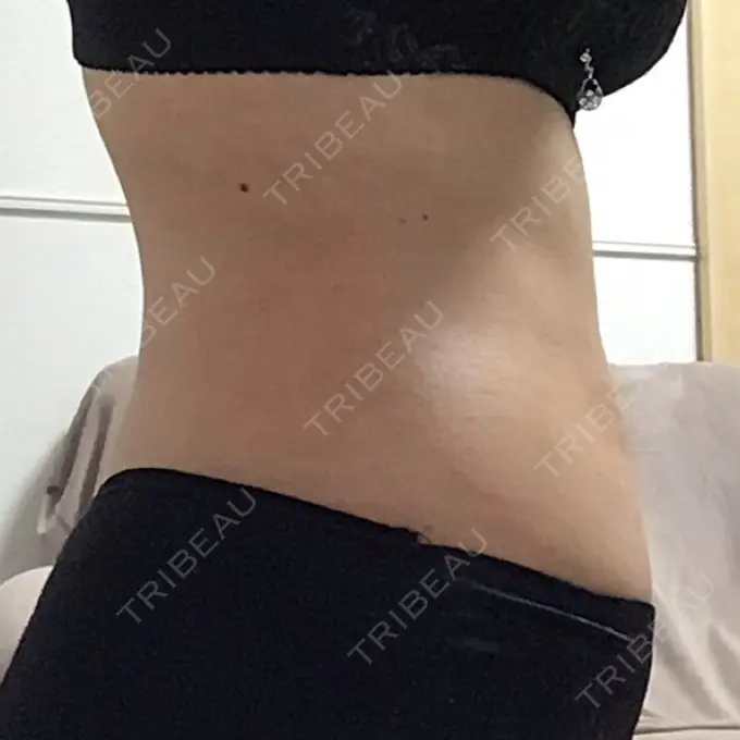 脂肪吸引（お腹） / その他（ボディ） THE CLINIC（ザ・クリニック） 福岡院 DAY 86 メイン用