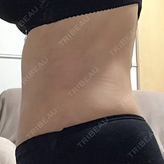 脂肪吸引（お腹） / その他（ボディ） THE CLINIC（ザ・クリニック） 福岡院 DAY 86 メイン用