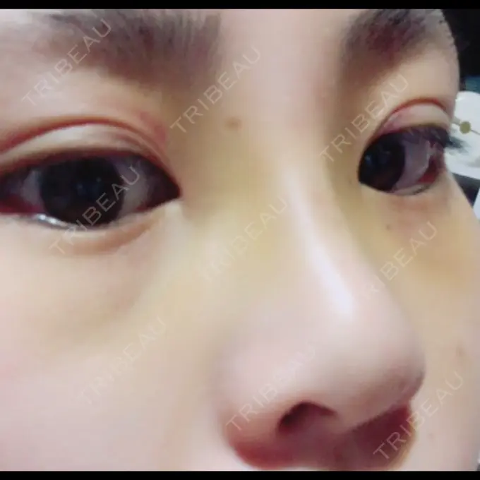 隆鼻術 湘南美容クリニック 柏院 DAY 4 メイン用