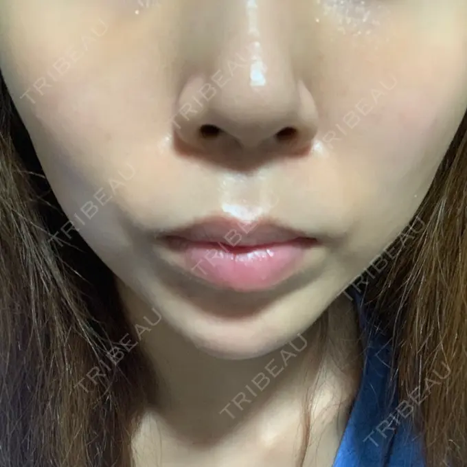 糸リフト MIL CLINIC OSAKA DAY 21 メイン用