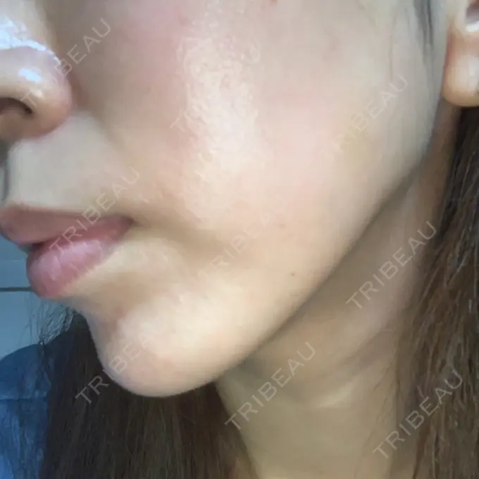 糸リフト MIL CLINIC OSAKA DAY 21 メイン用