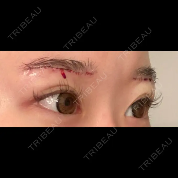 眉下切開 くさのたろうクリニック DAY 0 メイン用