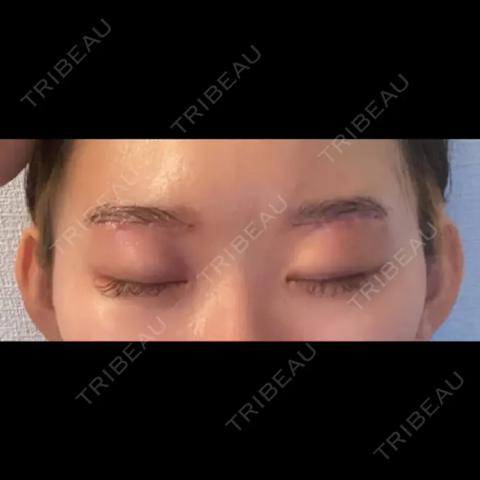 眉下切開 くさのたろうクリニック DAY 0 メイン用