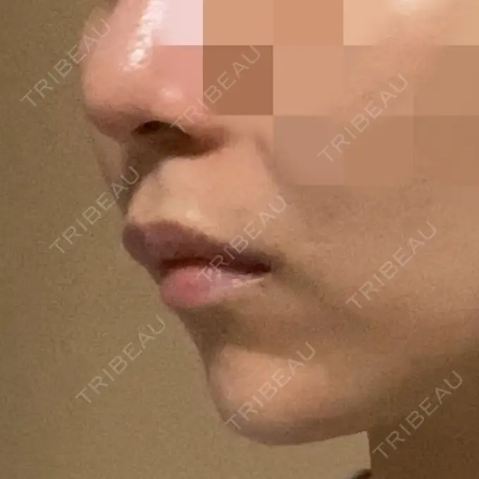 ボトックス（あご） / ヒアルロン酸注入（あご） / ボトックス（エラ・小顔） もとび美容外科クリニック 新宿院 DAY 5 メイン用