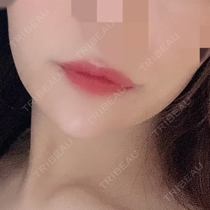 ボトックス（あご） / ヒアルロン酸注入（あご） / ボトックス（エラ・小顔） もとび美容外科クリニック 新宿院 DAY 7 メイン用