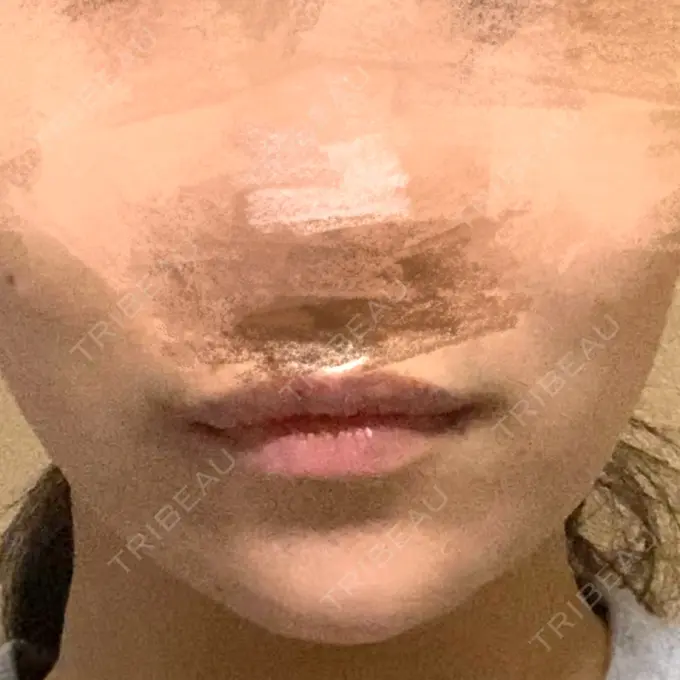 ボトックス（あご） / ヒアルロン酸注入（あご） / ボトックス（エラ・小顔） もとび美容外科クリニック 新宿院 DAY 10 メイン用