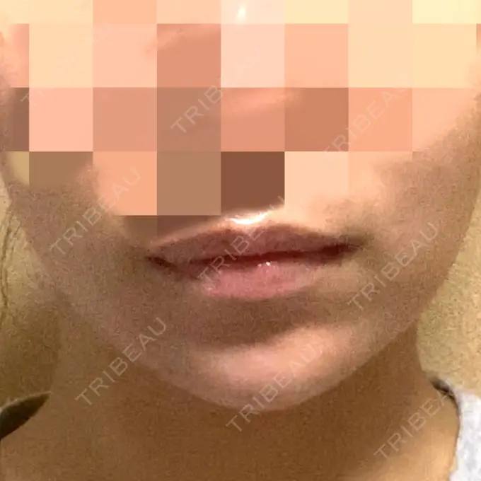 ボトックス（あご） / ヒアルロン酸注入（あご） / ボトックス（エラ・小顔） もとび美容外科クリニック 新宿院 DAY 20 メイン用