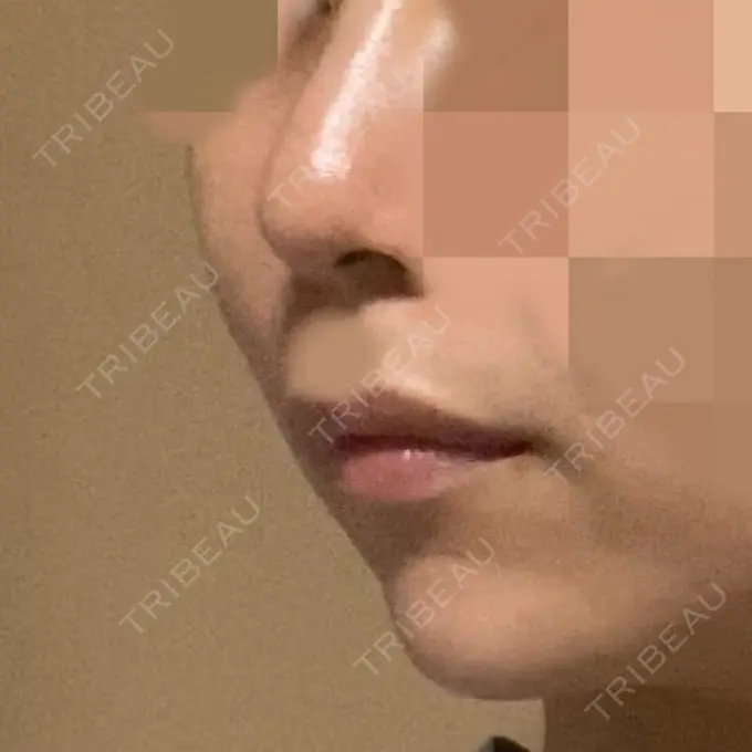 ボトックス（あご） / ヒアルロン酸注入（あご） / ボトックス（エラ・小顔） もとび美容外科クリニック 新宿院 DAY 15 メイン用