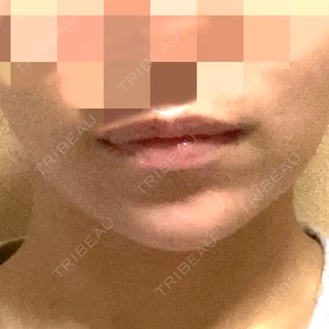 ボトックス（あご） / ヒアルロン酸注入（あご） / ボトックス（エラ・小顔） もとび美容外科クリニック 新宿院 DAY 30 メイン用