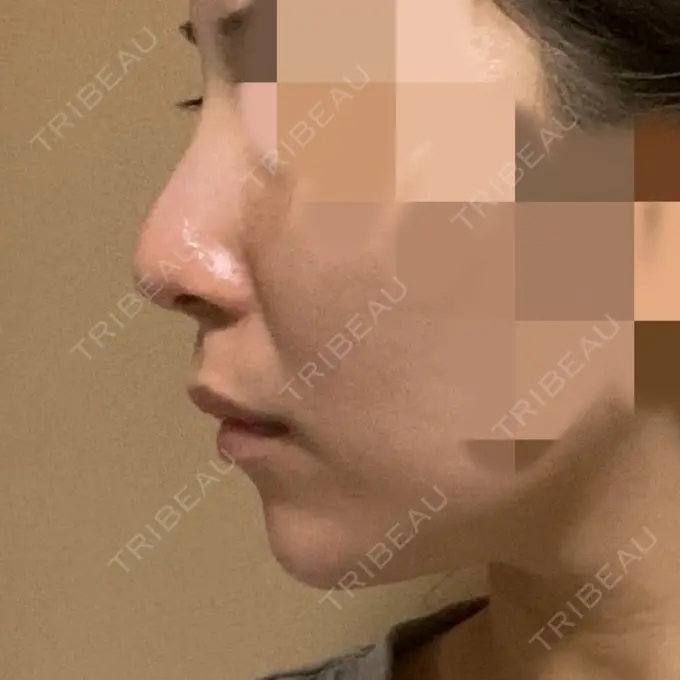 ボトックス（あご） / ヒアルロン酸注入（あご） / ボトックス（エラ・小顔） もとび美容外科クリニック 新宿院 DAY 28 メイン用