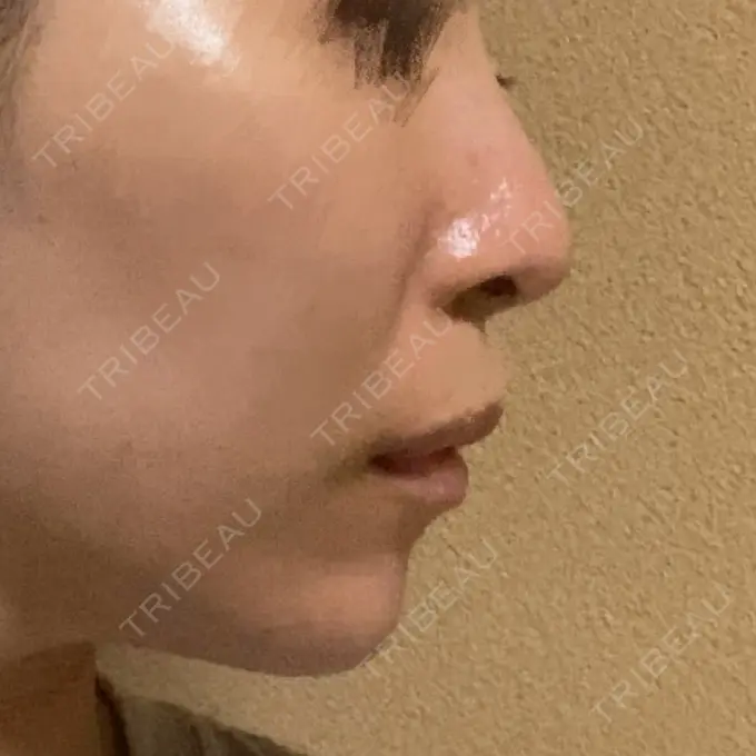 ボトックス（あご） / ヒアルロン酸注入（あご） / ボトックス（エラ・小顔） もとび美容外科クリニック 新宿院 DAY 25 メイン用