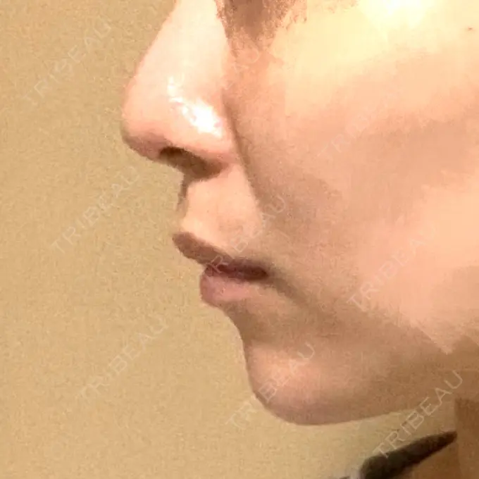 ボトックス（あご） / ヒアルロン酸注入（あご） / ボトックス（エラ・小顔） もとび美容外科クリニック 新宿院 AFTER メイン用