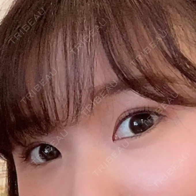 二重埋没 湘南メディカル記念病院（両国） DAY 13 メイン用