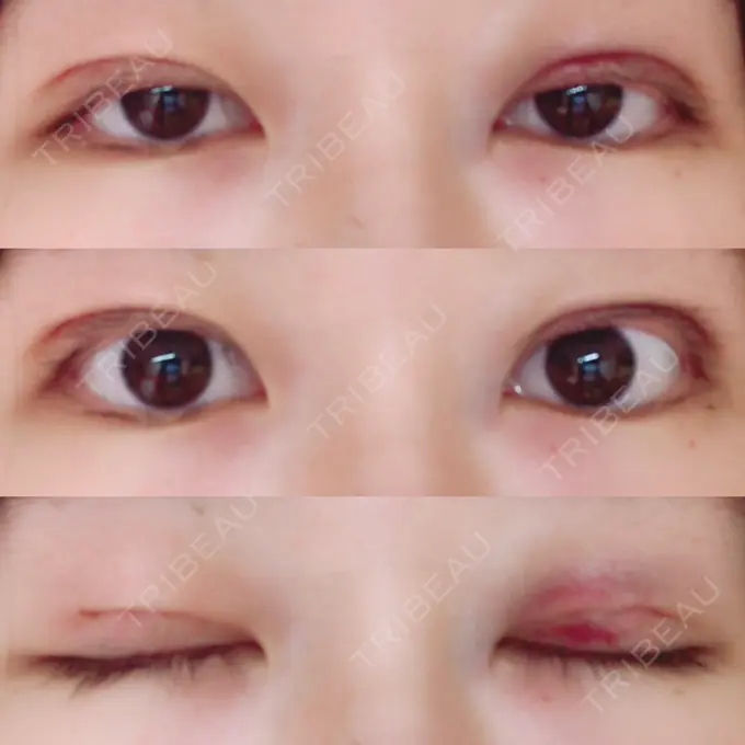 二重埋没 湘南美容クリニック 東京蒲田院 DAY 1 メイン用