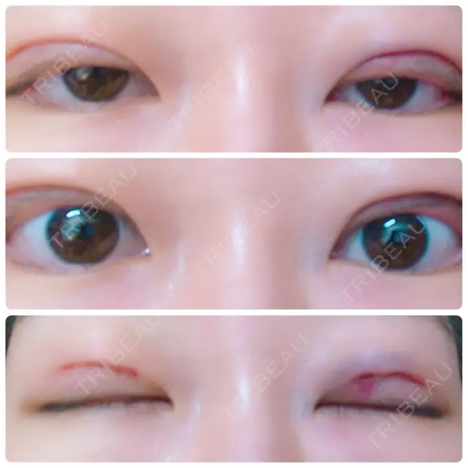 二重埋没 湘南美容クリニック 東京蒲田院 DAY 0 メイン用