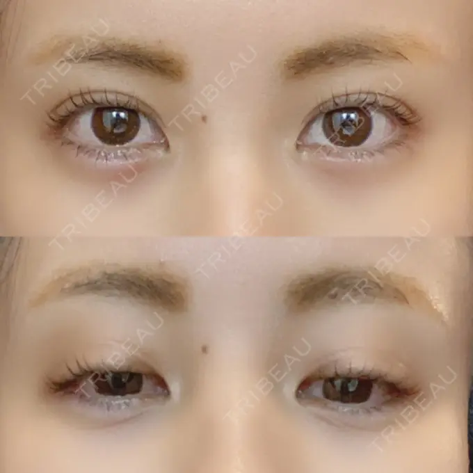 ヒアルロン酸注入（涙袋） フィラークリニック 新宿院 DAY 0 メイン用